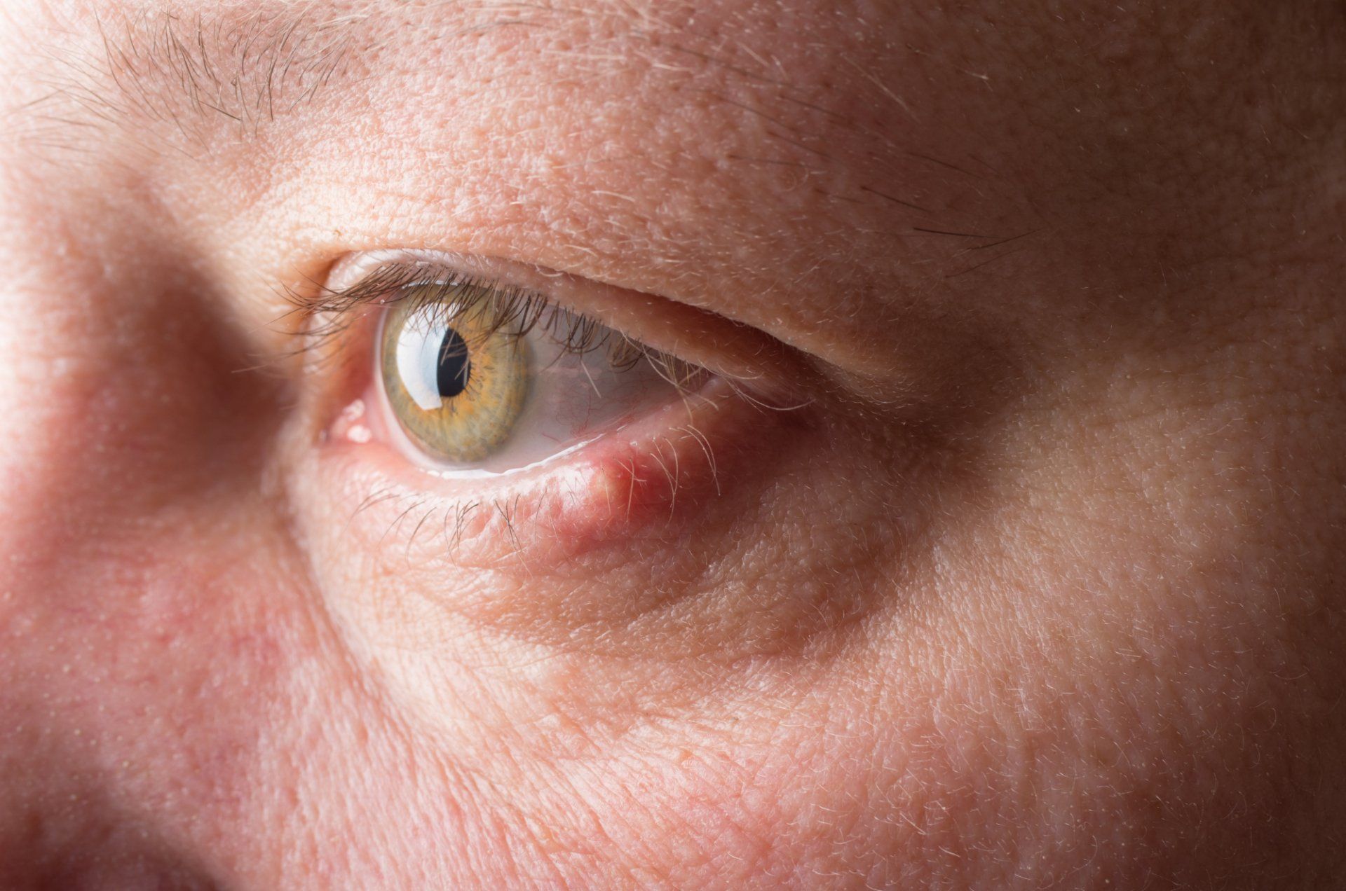 stye on the eye of a patient at Eye Associates of North Jersey