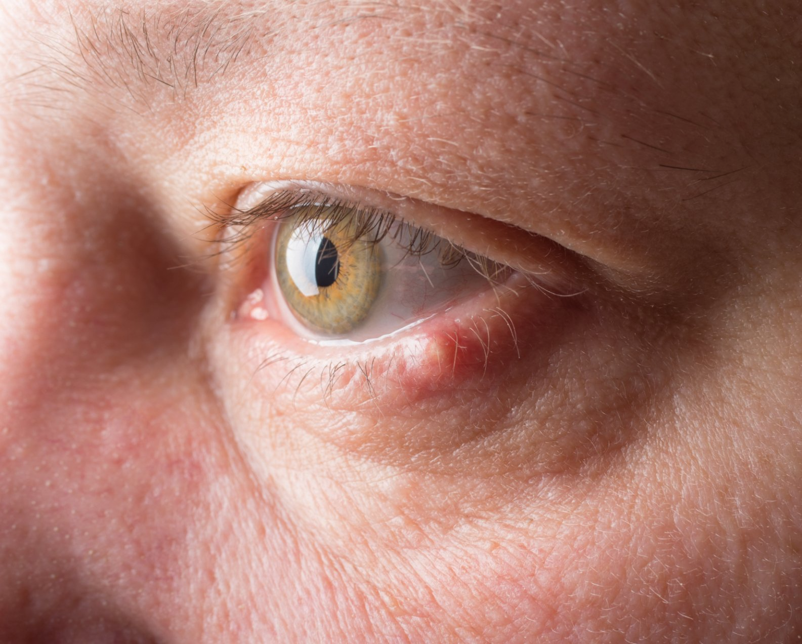 closeup of man with stye on eye