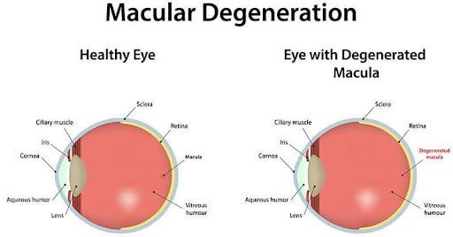 macular degeneration