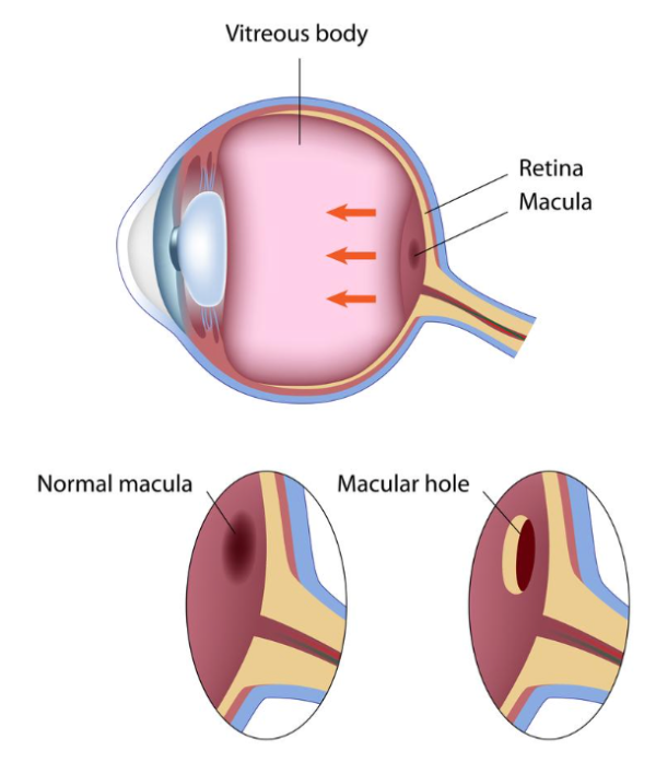 A diagram of a normal macula and a macular hole