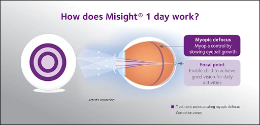 how does misight 1 day work? infographic