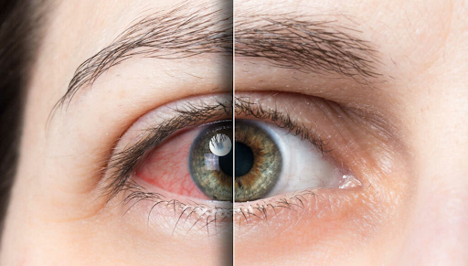 before and after red eye 