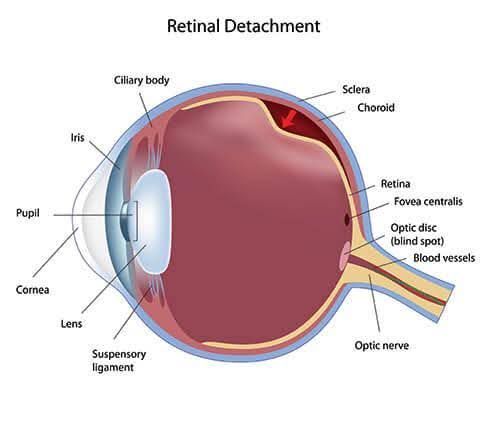 retinal detachment