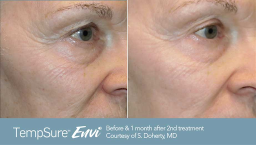 tempsure envi patient photo before and after