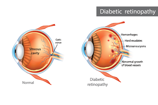 diabetic retinopathy