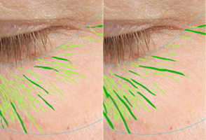 real patient's wrinkle analysis with VISIA