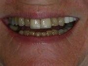 A close up of a person 's mouth with their teeth showing.