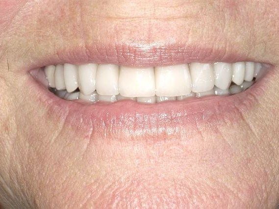 A close up of a woman 's smile with white teeth.