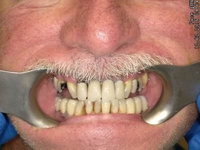 A close up of a man 's mouth with a brace on his teeth.
