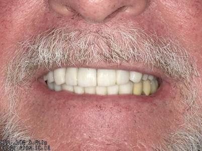 A close up of a man 's mouth with a beard and white teeth.