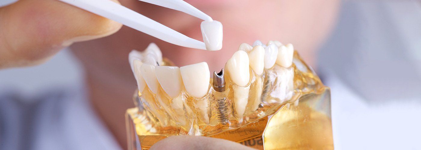 Ashburn dentist teeth restoration program