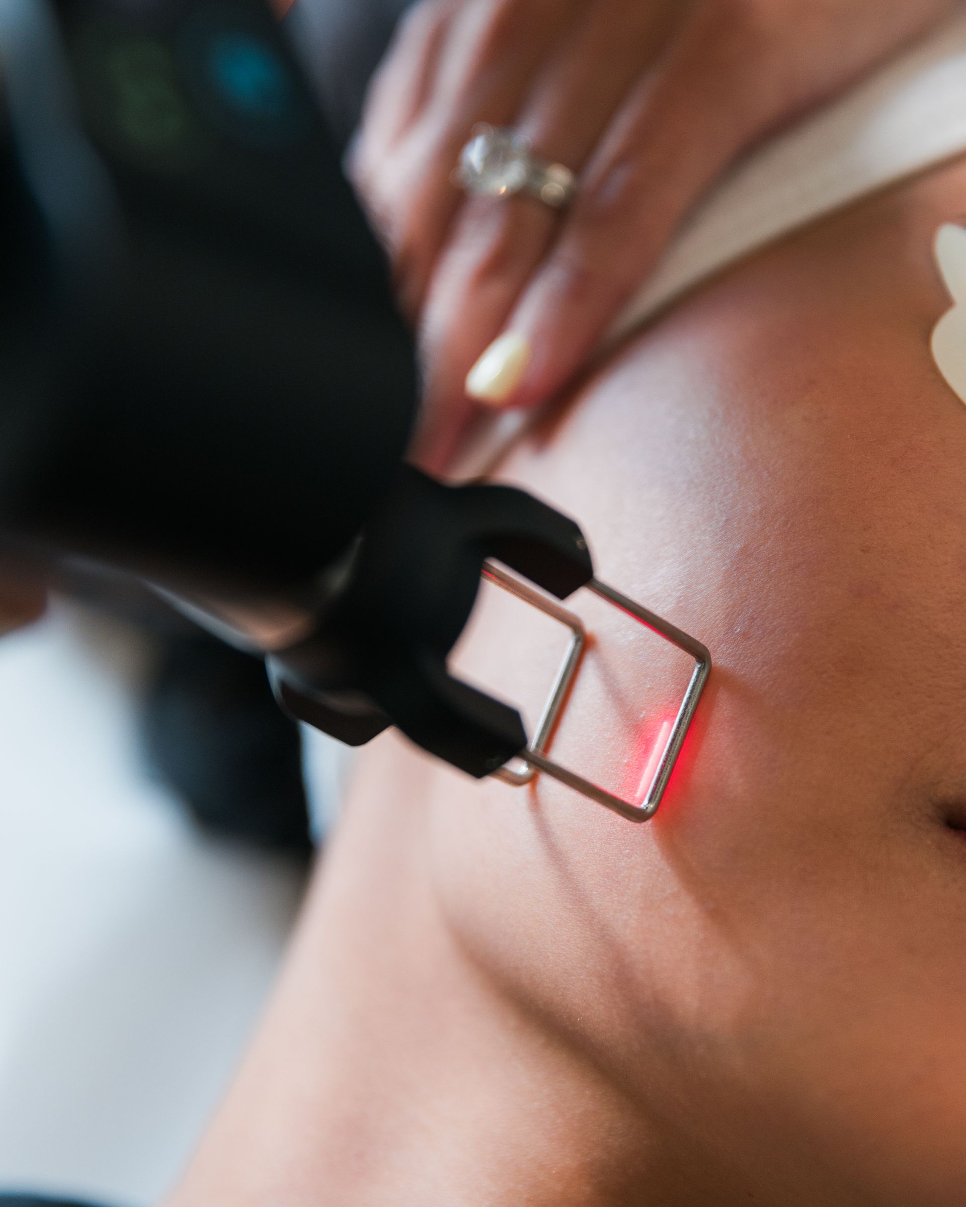 A woman is getting a laser treatment on her shoulder