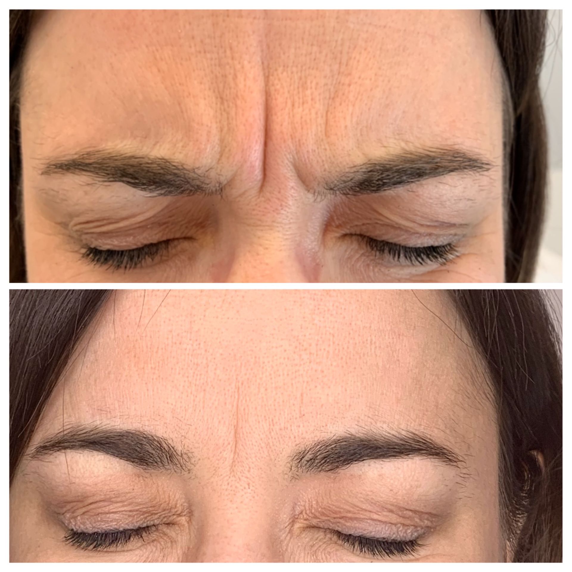 Botox and Dysport Before & After Image