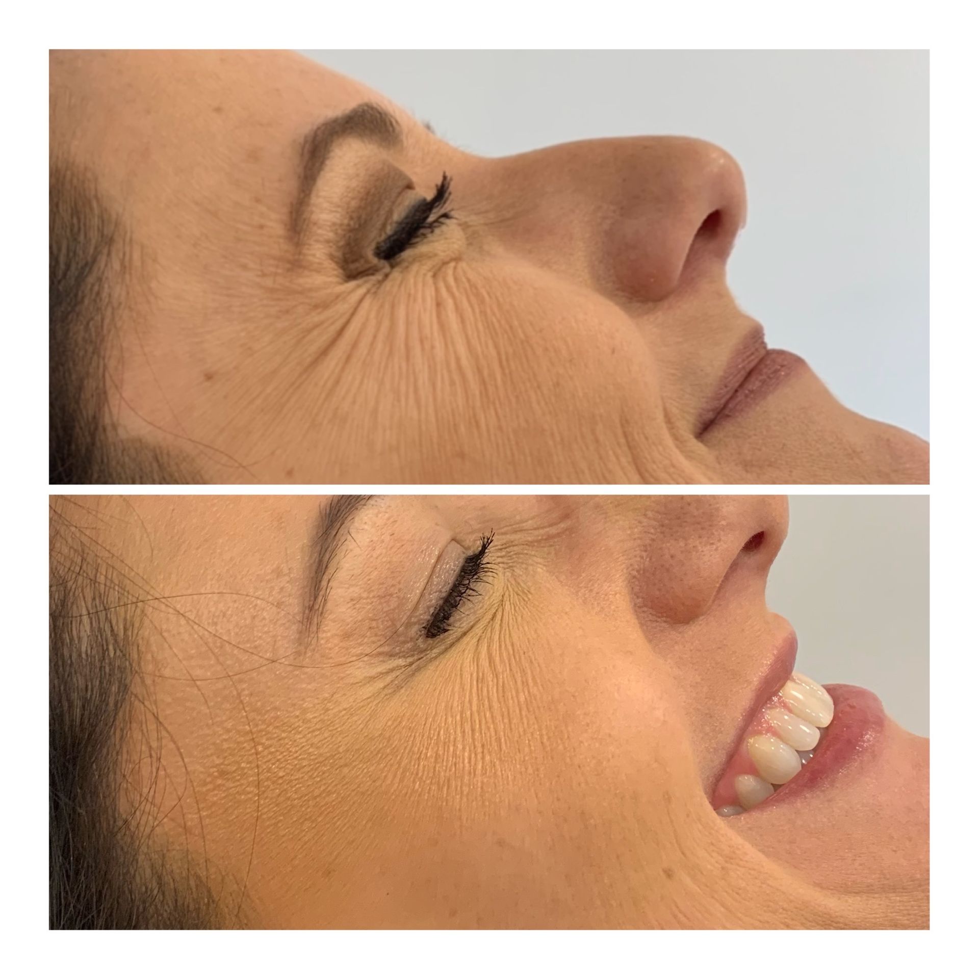 Botox and Dysport Before & After Image