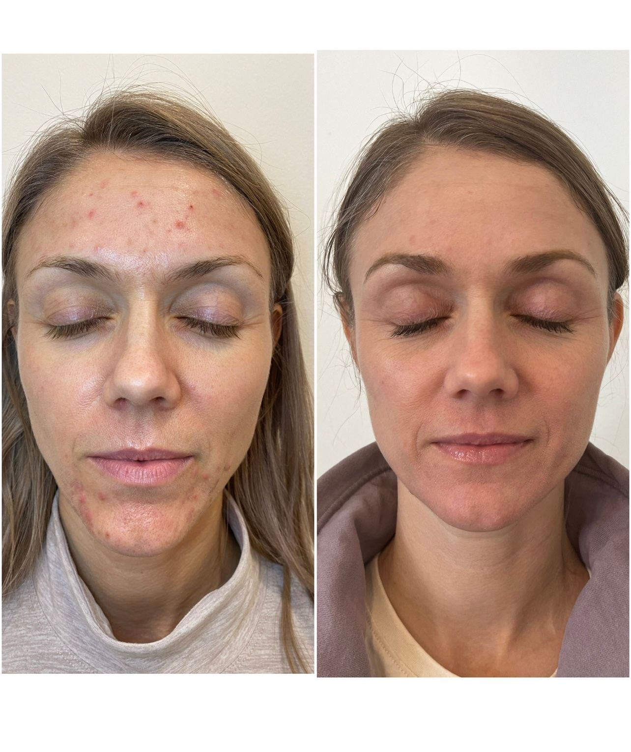 Laser Skin Treatments Before & After image