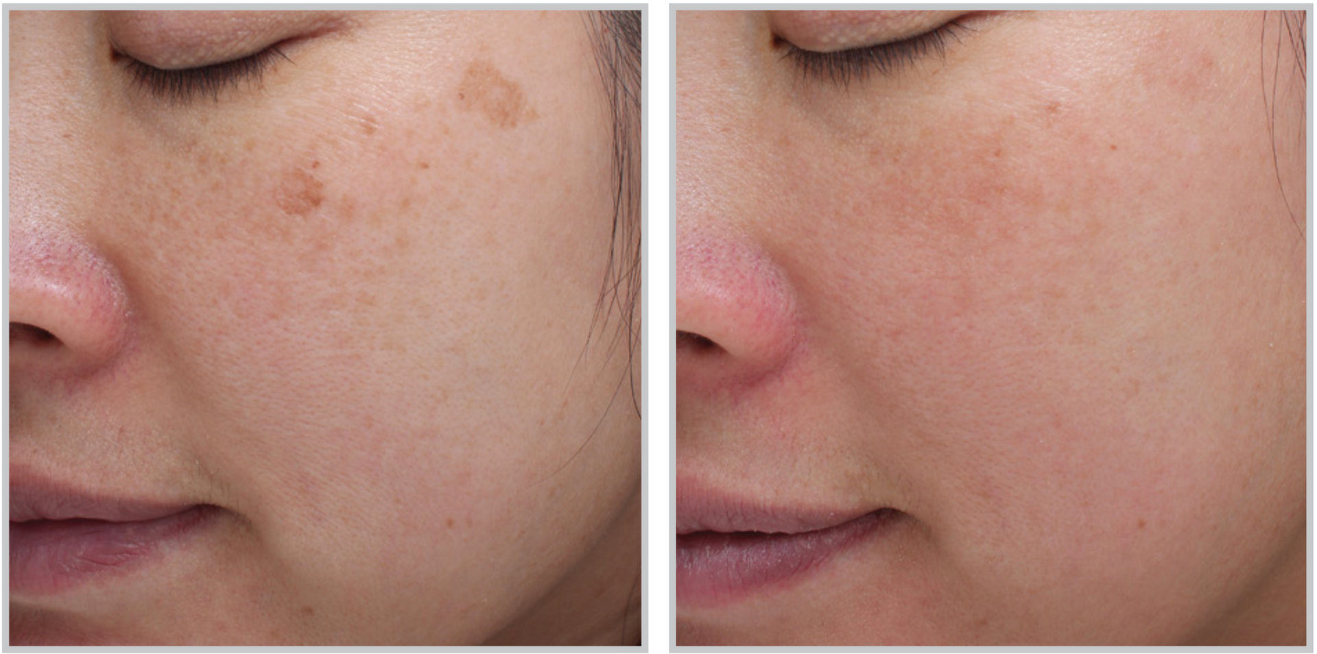 A before and after photo of a woman 's face with freckles.