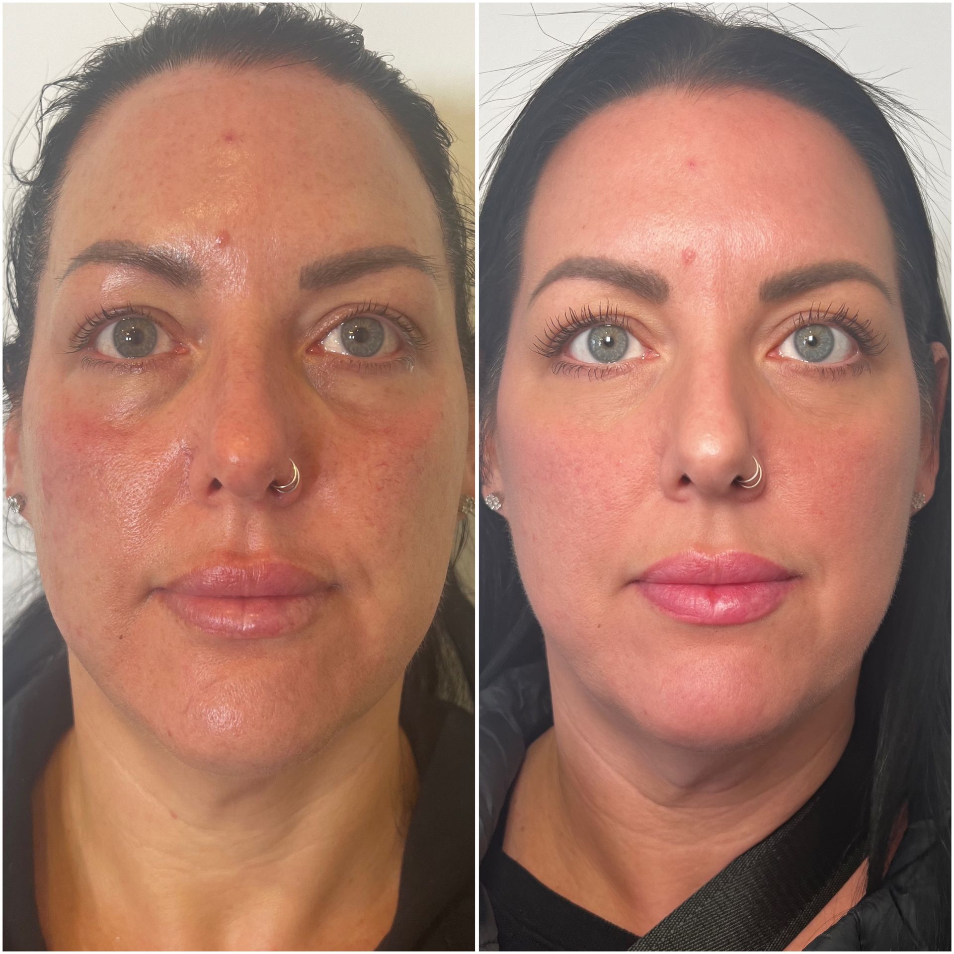 Laser Skin Treatments Before & After image