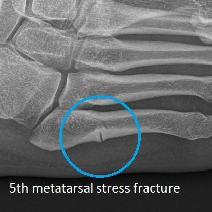 5th Metatarsal Stress Fracture