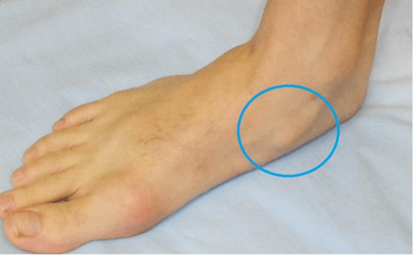 Bony growth on side of foot new arrivals