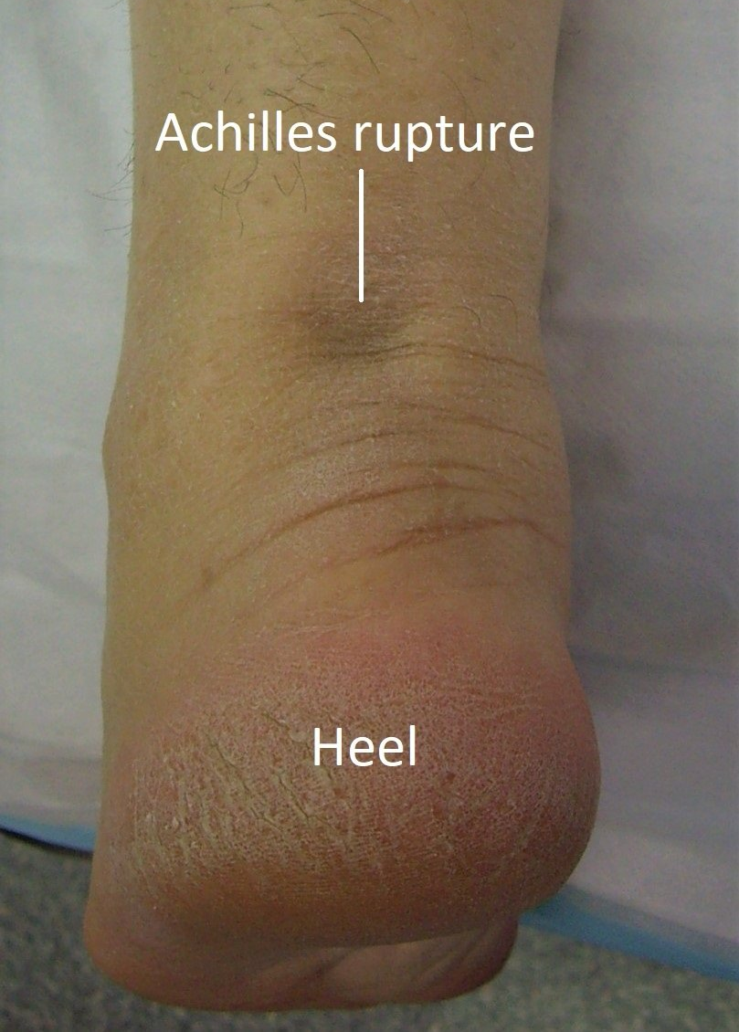 achilles-tendon-rupture-dr-ben-beamond-adelaide