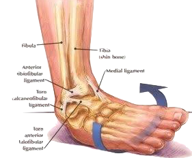 Ankle Sprain Dr Ben Beamond Foot Ankle Orthopaedic Surgeon Adelaide