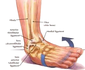 Ankle Sprain, Ankle, Dr Ben Beamond