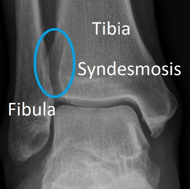 High Ankle Injury Ankle Dr Ben Beamond Adelaide