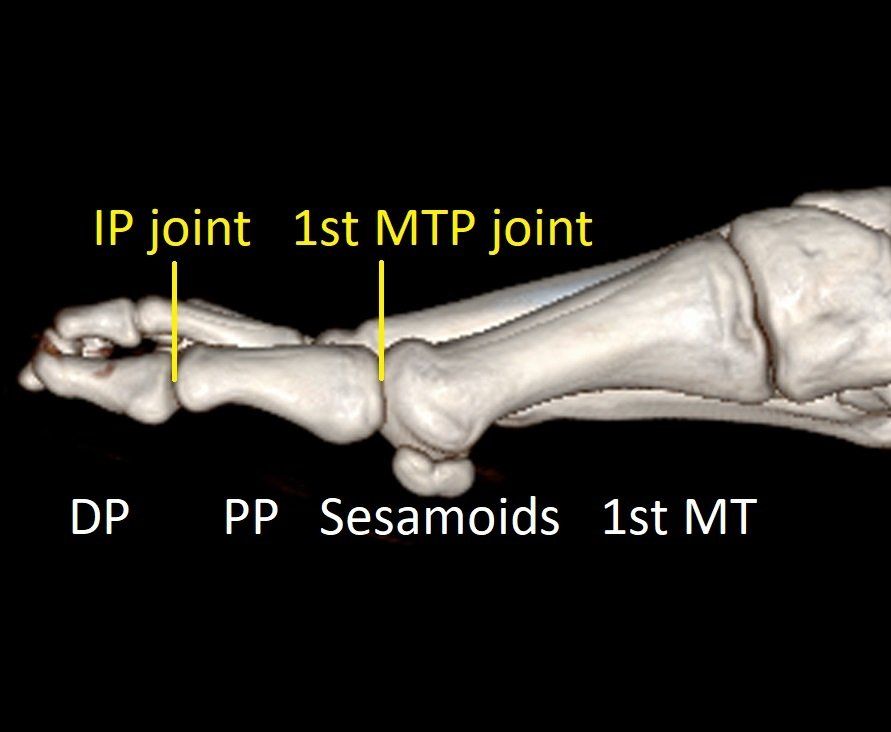 Big Toe 1st MTP Fusion Dr Ben Beamond Adelaide   Bones Medial 1920w 