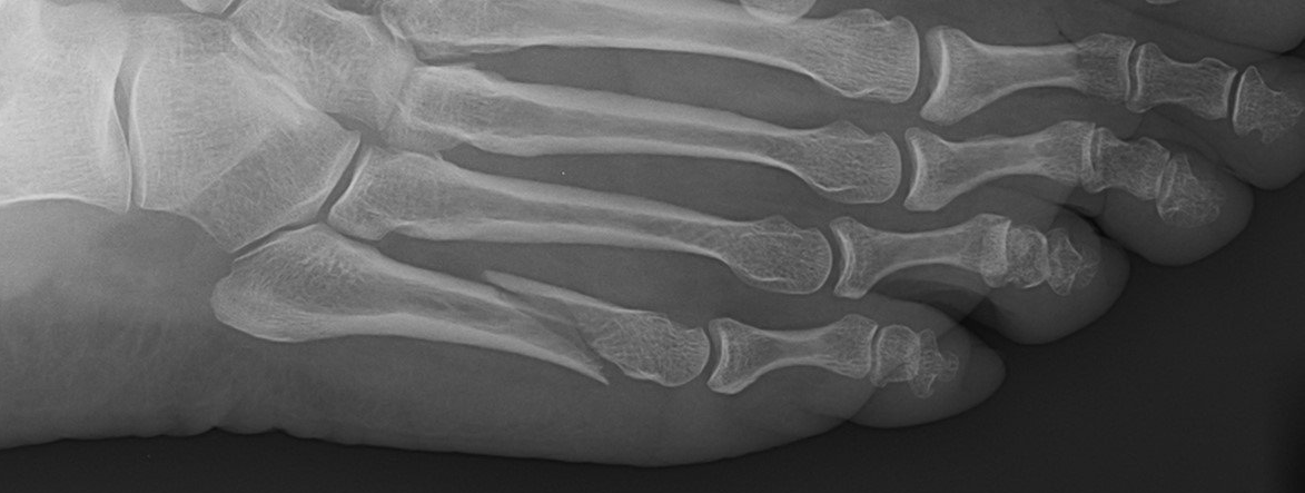 5th Metatarsal Fracture Dr Ben Beamond Adelaide 8293