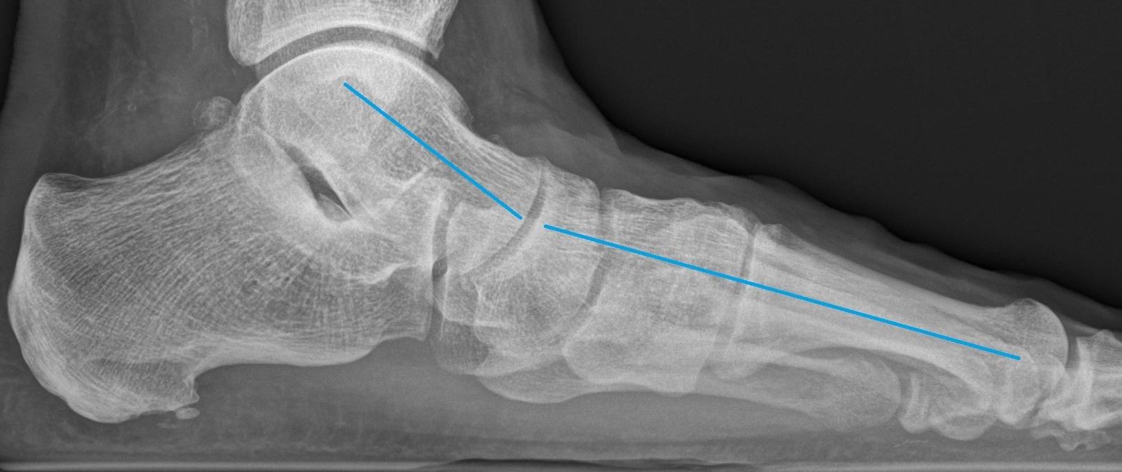 Flat foot reconstruction recovery