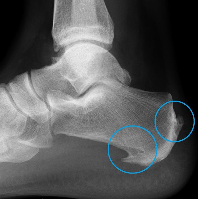 Xray Ankle Bone Spurs Plantar Fasciitis And Spurs A Bone Spur In The Heel