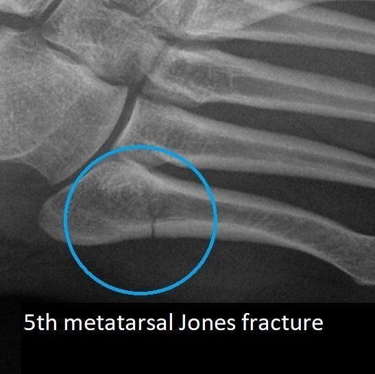 5th Metatarsal Jones Fracture