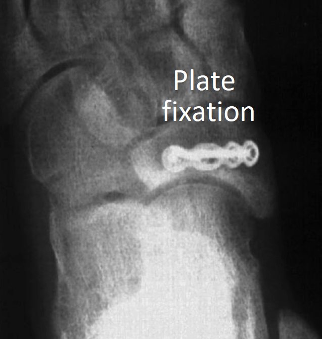 Nav Plate Fixation