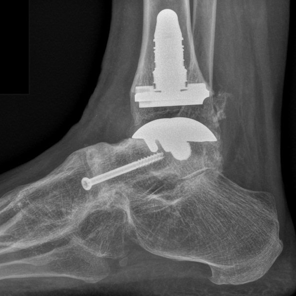 Ankle Fusion And Replacement Dr Ben Beamond Adelaide
