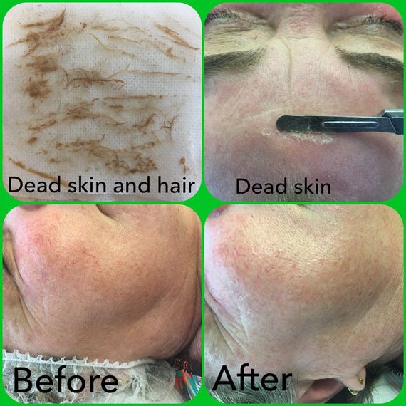 Removing Dead Skin — Beauty Salon In Albion Park, NSW
