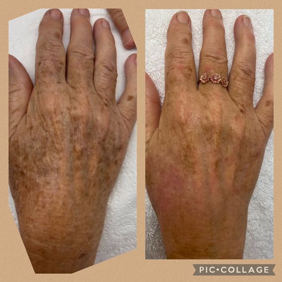 Pigmentation Treatment on Hands — Beauty Salon In Albion Park, NSW