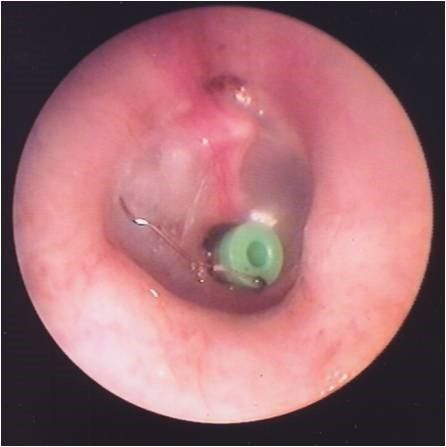 Intervento all'orecchio