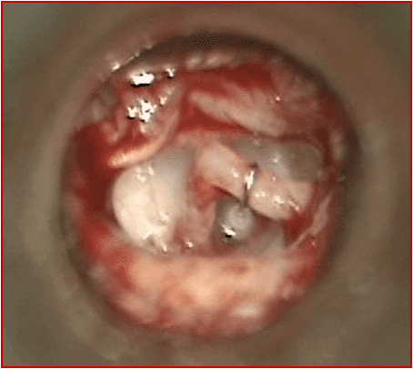 Intervento all'orecchio