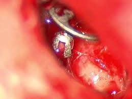 Intervento all'orecchio