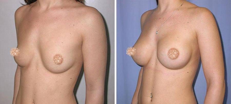 esempio 5 di seno sottoposto a mastoplastica di aumento