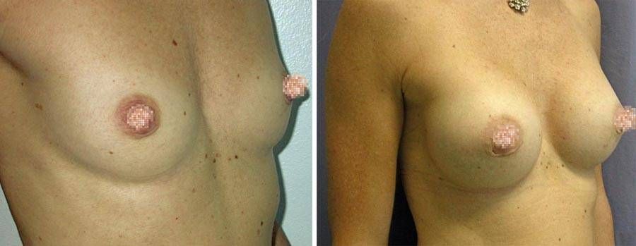 esempio 9 di seno sottoposto a mastoplastica di aumento