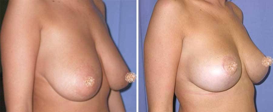 eno sottoposto a Mastoplastica Riduttiva - esempio 5