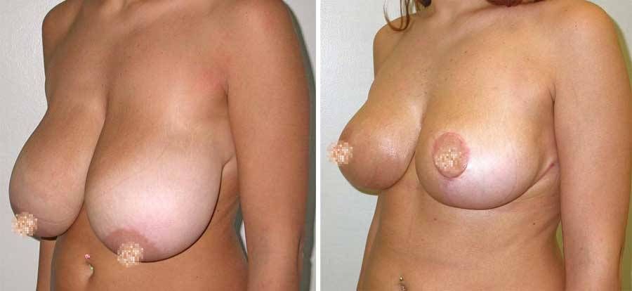 eno sottoposto a Mastoplastica Riduttiva - esempio 4