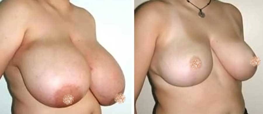 eno sottoposto a Mastoplastica Riduttiva - esempio 3