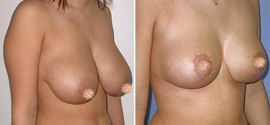 seno sottoposto a Mastoplastica Riduttiva - esempio 1