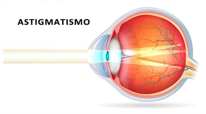 DRA. MÓNICA FLORES ACOSTA-Astigmatismo