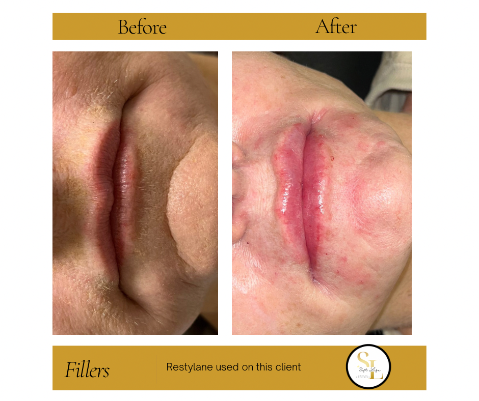 A before and after photo of a person 's lips