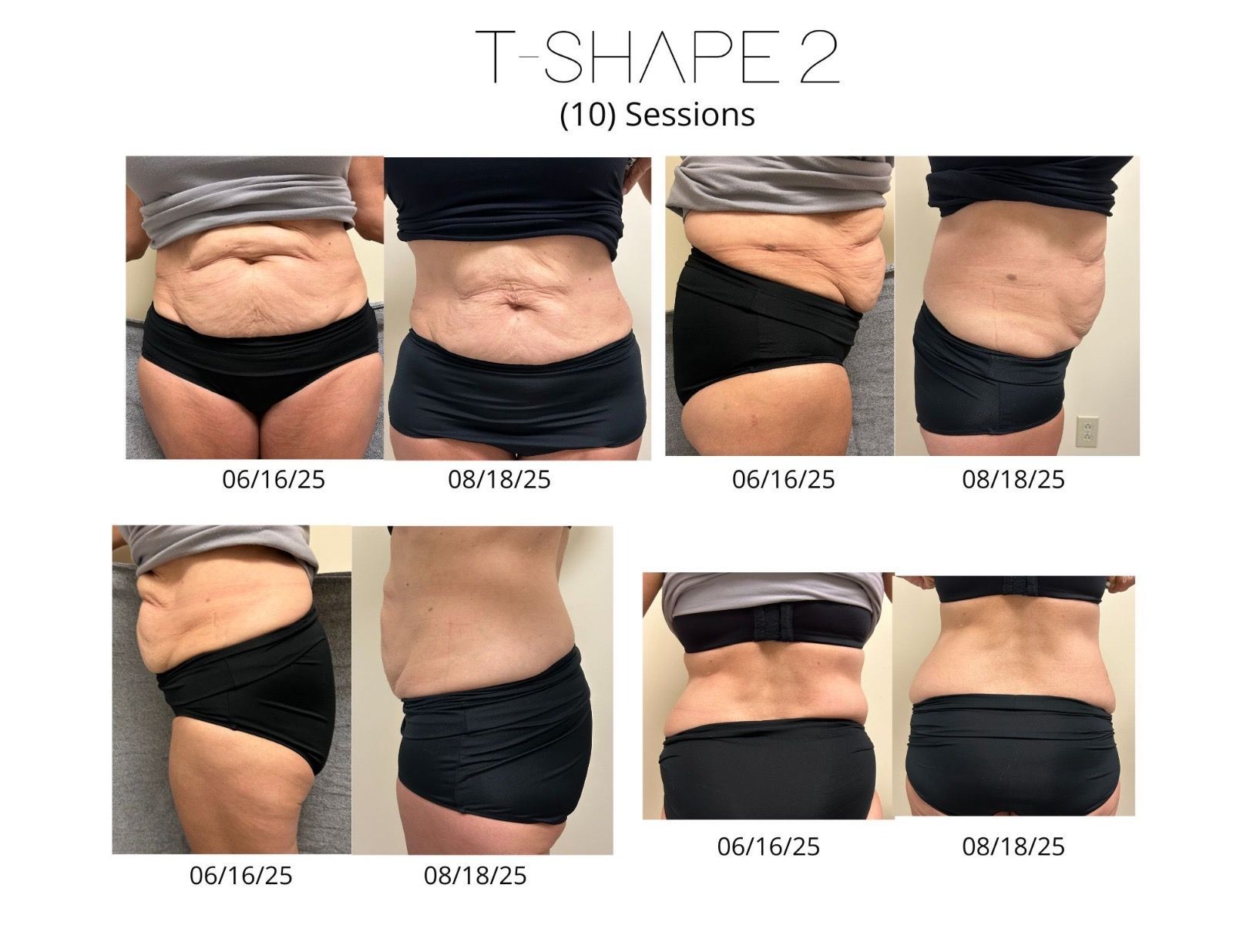 Comparison of a person's torso, before and after 10 T-Shape 2 sessions. Shows front and side views of the abdomen.