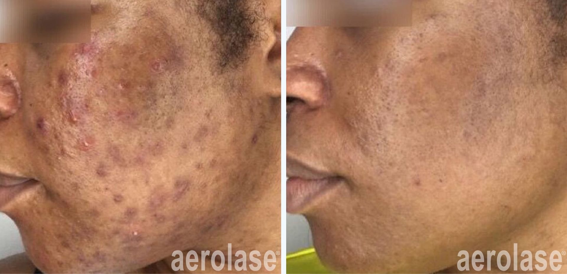 A before and after photo of a woman 's face with acne.