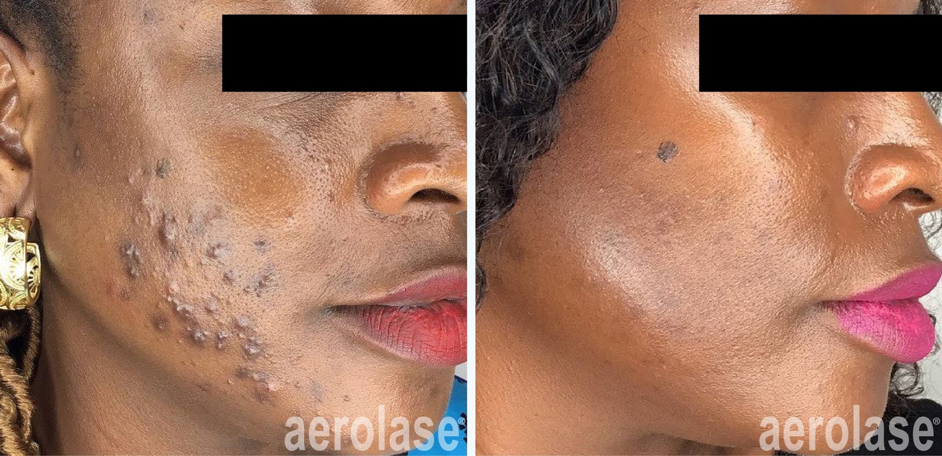 A before and after photo of a woman 's face with acne.